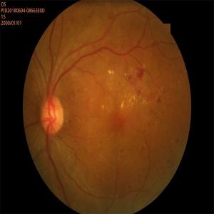 Automated Retinal Fundus Camera Non Contact High Resolution