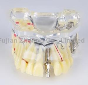 Quality dental caries dental bridge dental teaching communication oral implant nail demonstration model for sale