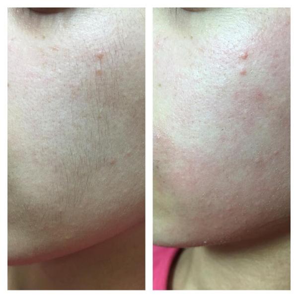 Intelligent Operating E Light Beauty Machine , Yag Laser Machine Smooth Fine Wrinkles