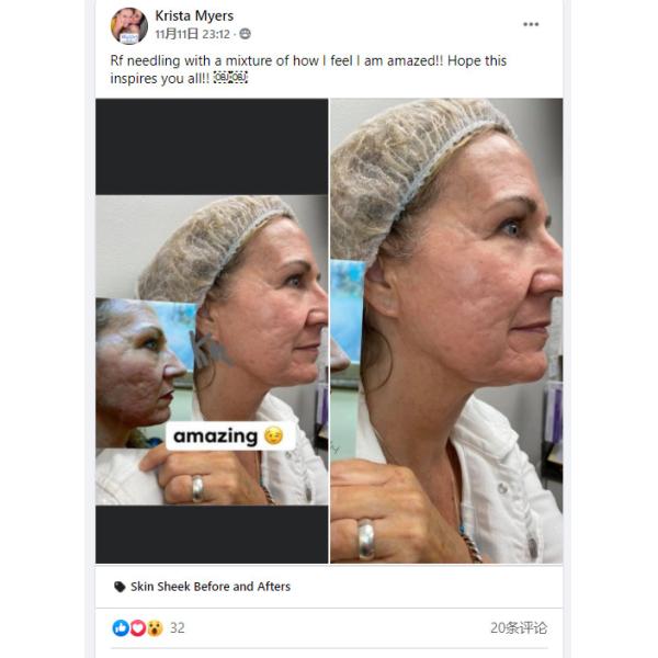 Shrinking Pores RF Microneedling Machine Tender Skin Dot Matrix Pixel Laser