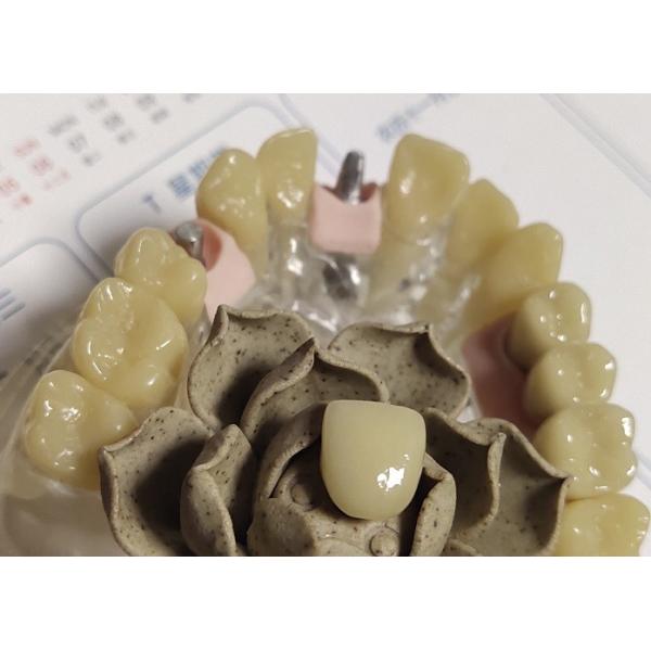 CAD Technique ISO13485 Interim Crown