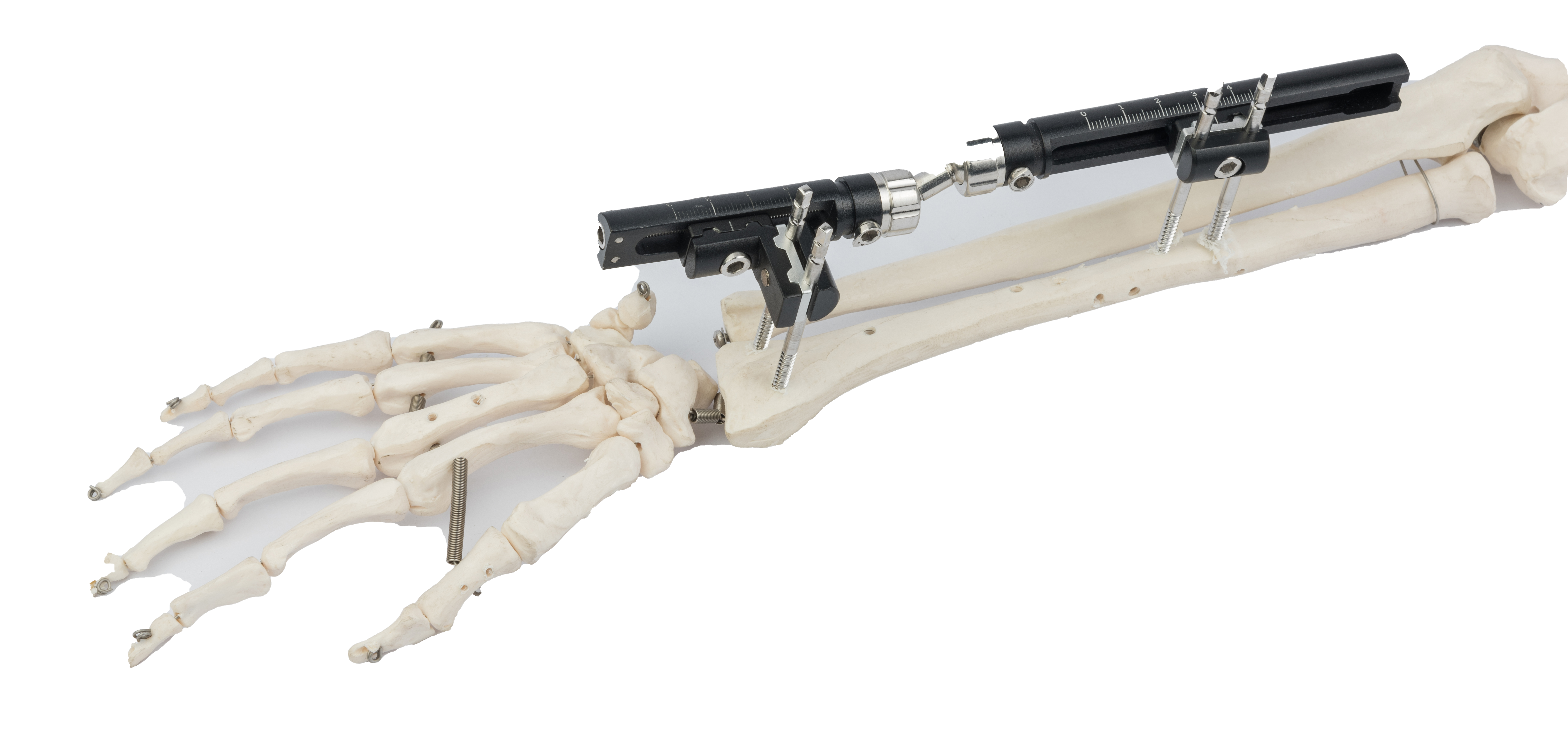 CE / ISO Orthopedic External Fixator Trauma Sterilized Fracture Distal Radius