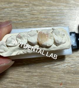 Quality VIVI Composite Dental Inlay Onlay High Esthetics ISO Certified for sale