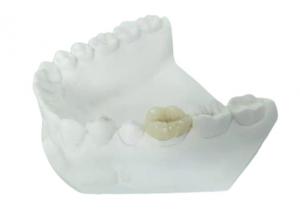 China Durable FDA All-Ceramic Dental Crown Veneer Inlay Onlay Similar on sale