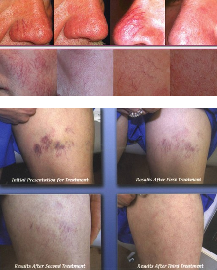 Advanced immediately effect 500W Spider Vein Removal Machine