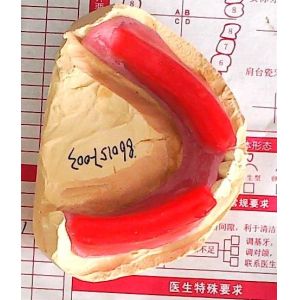 Biteblocks For Jaw Relation Before Complete Denture