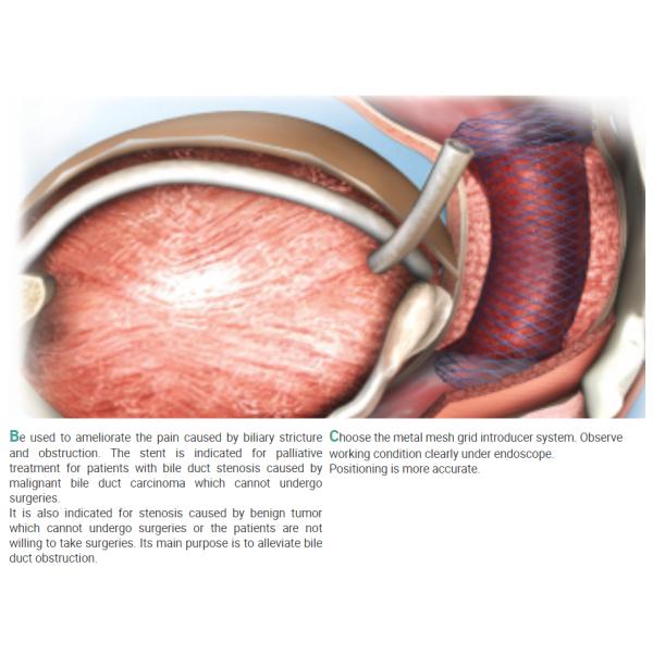 Endoscopic Ni-Ti Biliary Stent Disposable Customized Ce Certified