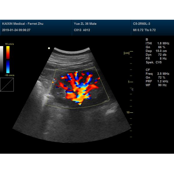 Notebook Laptop Ultrasound Scanner Color Doppler Machie With 15'' LED Monitor