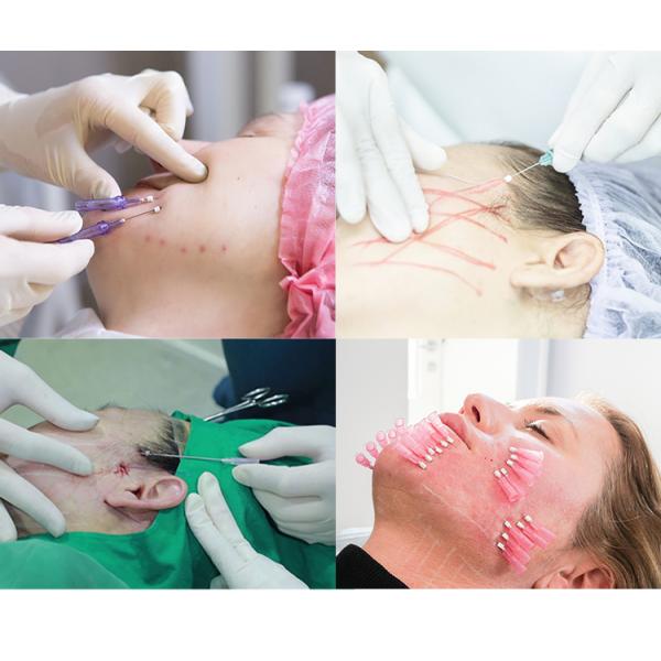 27g 30g PDO PCL PLLA Threads 25mm 38mm V Line Thread Lift