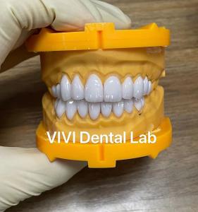 China Ivoclar Emax Laminate Veneers High Translucency China Dental Lab on sale