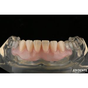 Personalized Invisible Denture Finished With Advanced Tooth Arrangement