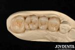 Multilayer Full Zirconia White Style With Layers High Translucency High