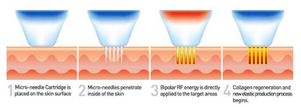 200W High Energy Output Fractional RF MicroNeedle Machine Thermolysis for Collagen regeneration