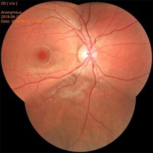 Autofocus Non Mydriatic Fundus Camera System For Cataracts Check
